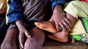 20-pays-africains-touches-par-le-virus-mpox-africa-cdc