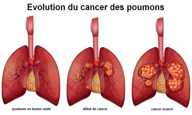 cancer-du-poumon-une-pathologie-multifactorielle